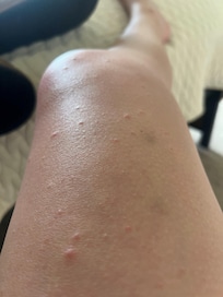 The smaller bedroom has bed bugs. My daughter-in-law has them on her legs and torso.
