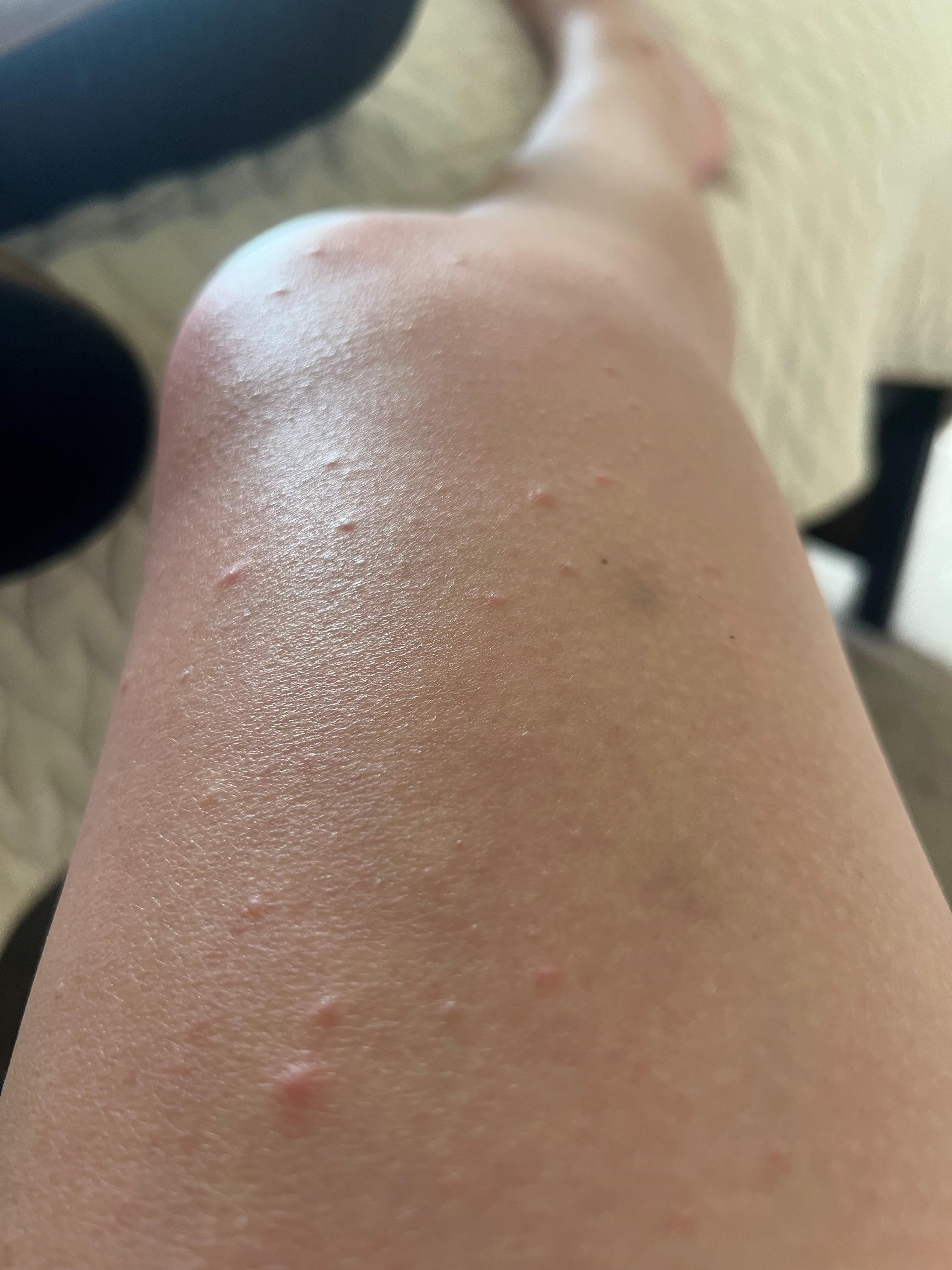 The smaller bedroom has bed bugs. My daughter-in-law has them on her legs and torso. 