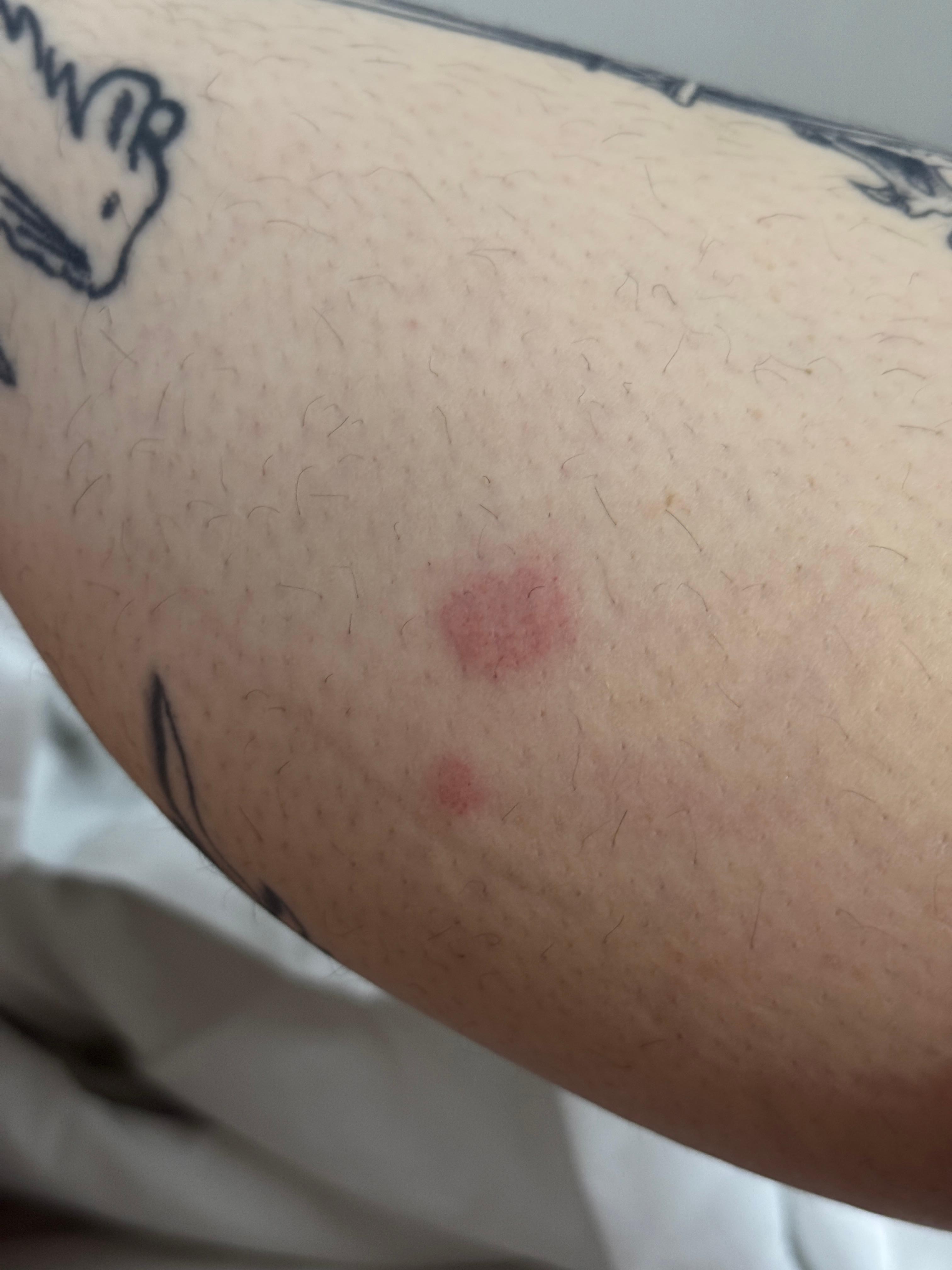 bed bug bites everywhere