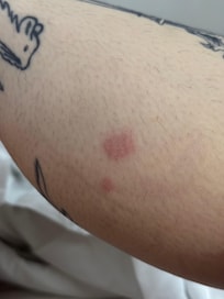 bed bug bites everywhere
