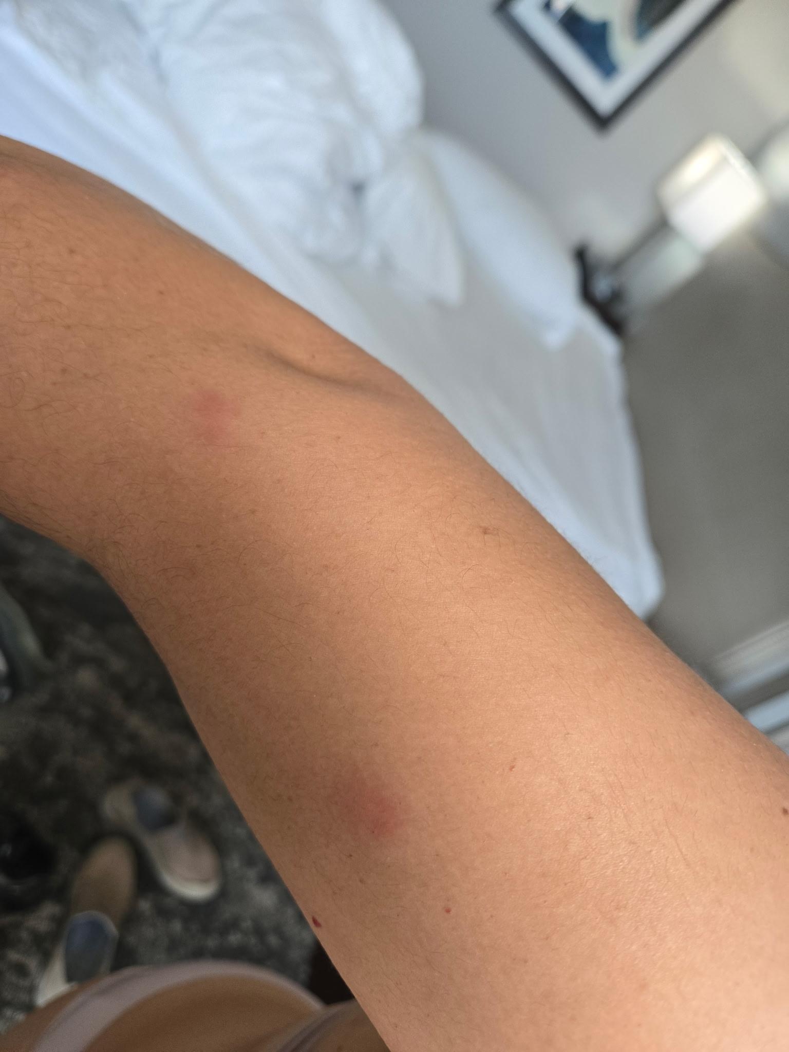 Just some of the multiple bites received on my arms.
