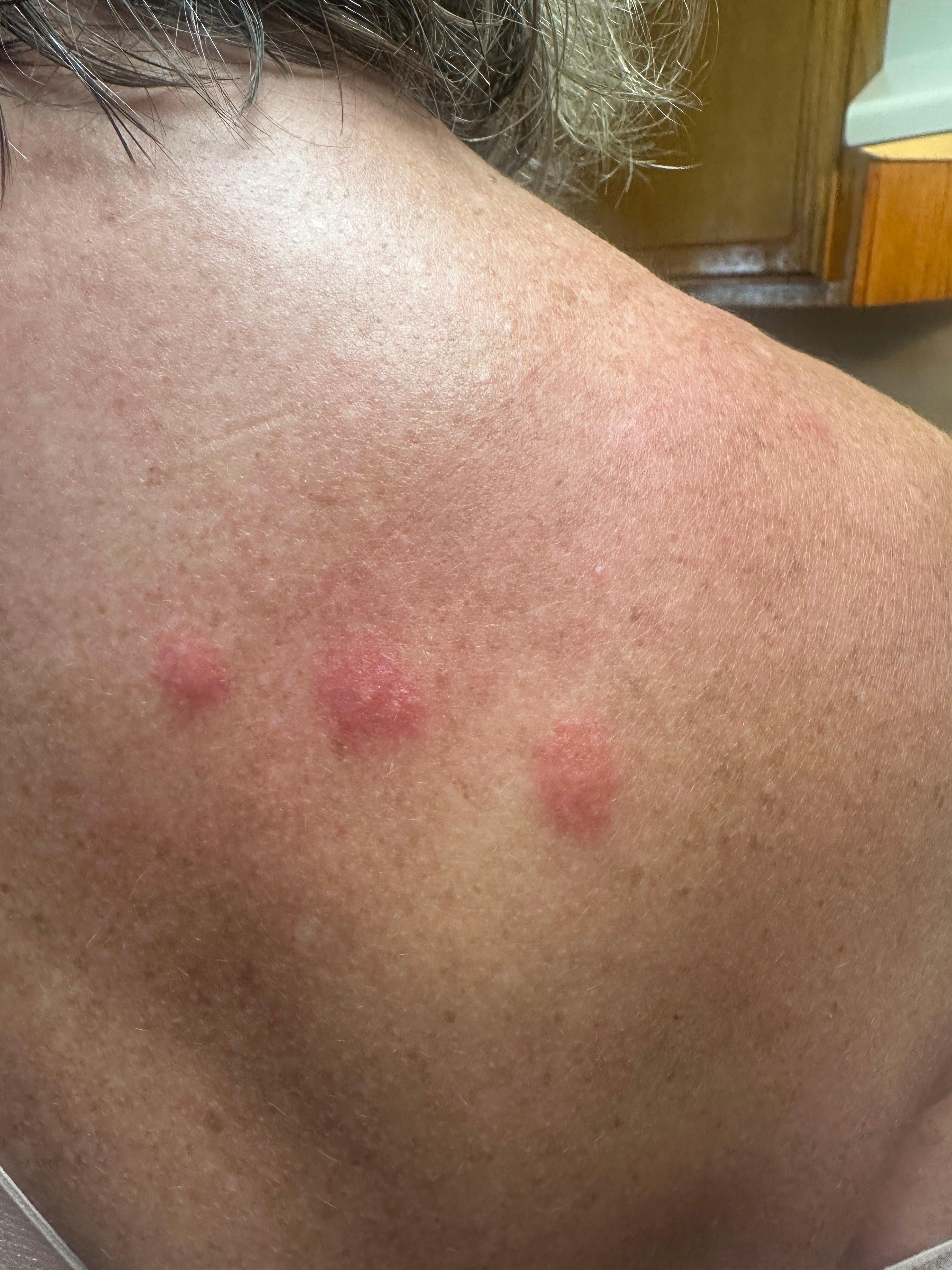 Bed bug bites