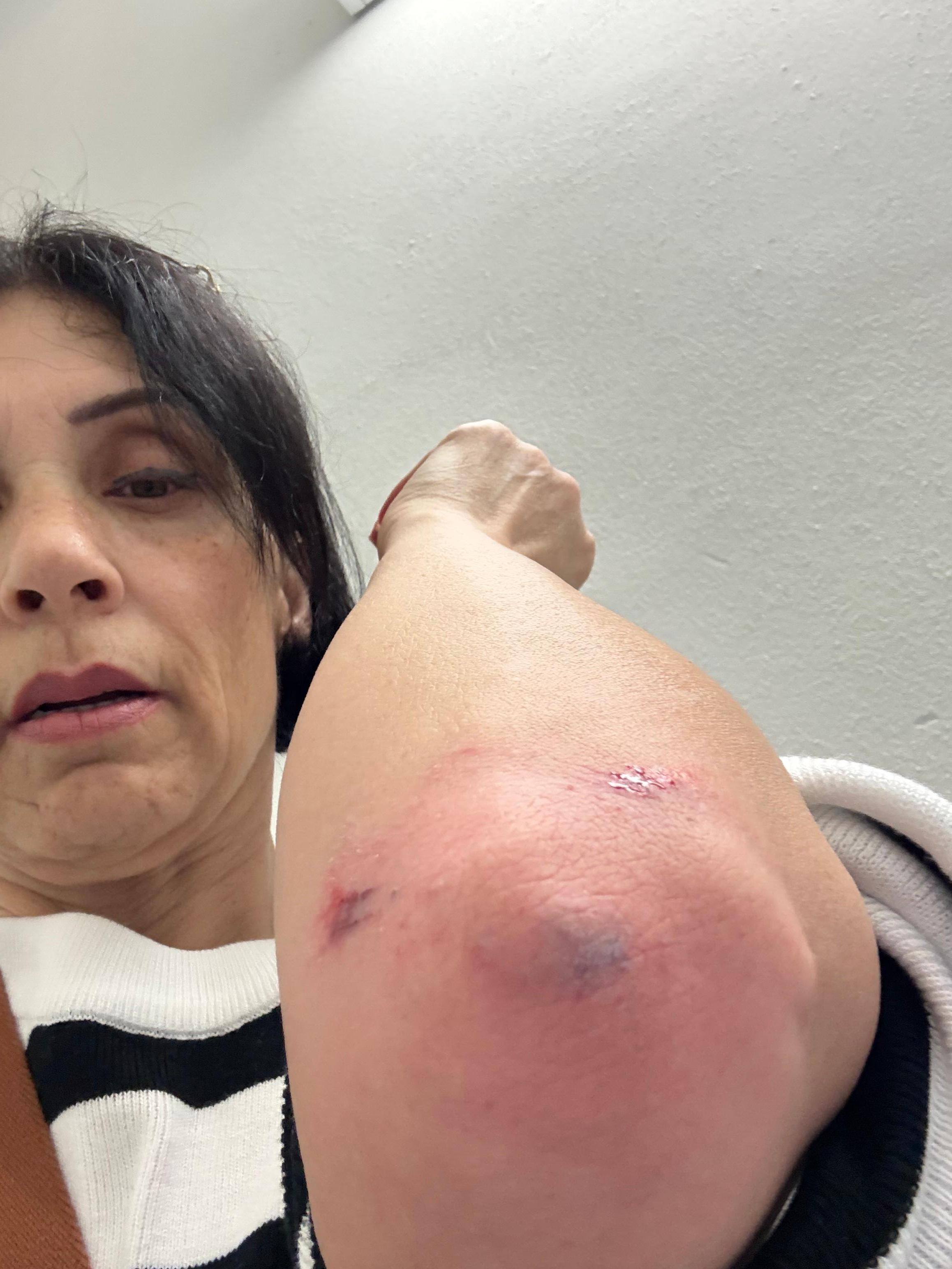 Fell down the stairs 