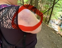 Bruise on shoulder after falling in the shower.