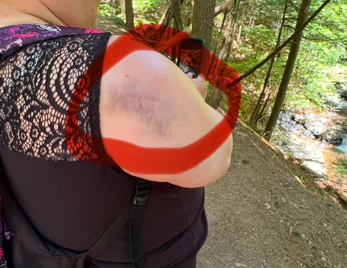 Bruise on shoulder after falling in the shower. 