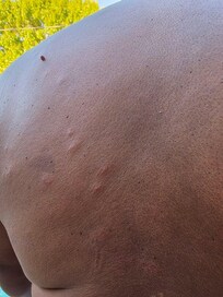 Allergic reaction to bed bug bites