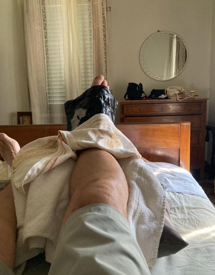 Here is my friend's injured leg.  The doctor advised 20 min. of compress 3x/day, and it can take up to 6 mos. to heal.
