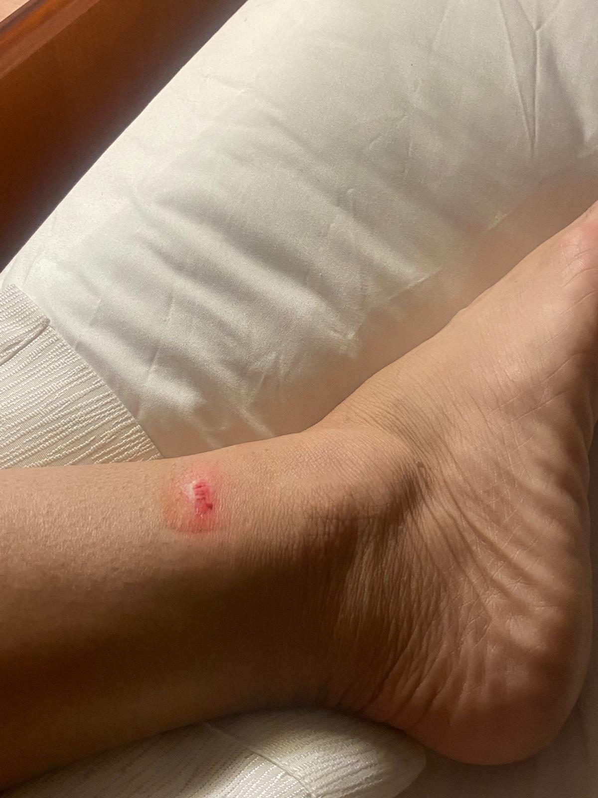 Swoll n and cut on my ankle