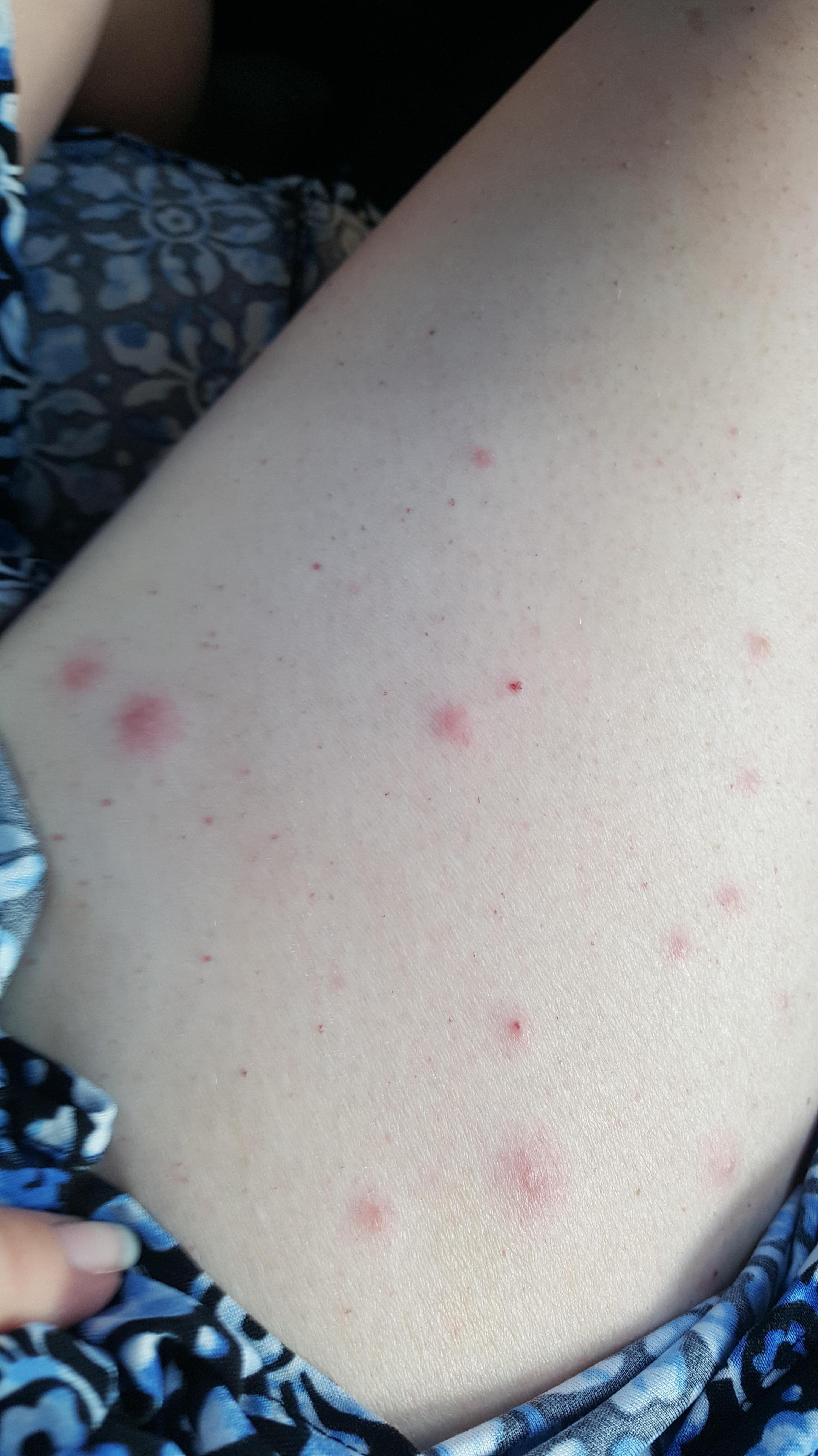 Bed bugs