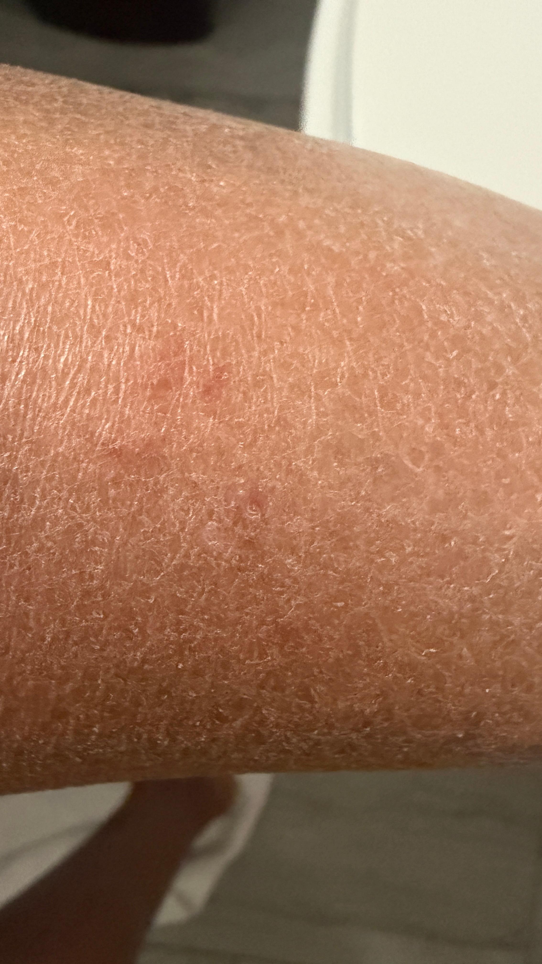 I felt a pinch while sleeping and when I looked this is what I saw. 