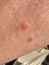 Bedbug bites on arm