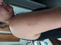 Bed Bug bites