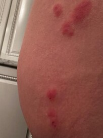 Bed bugs sadly