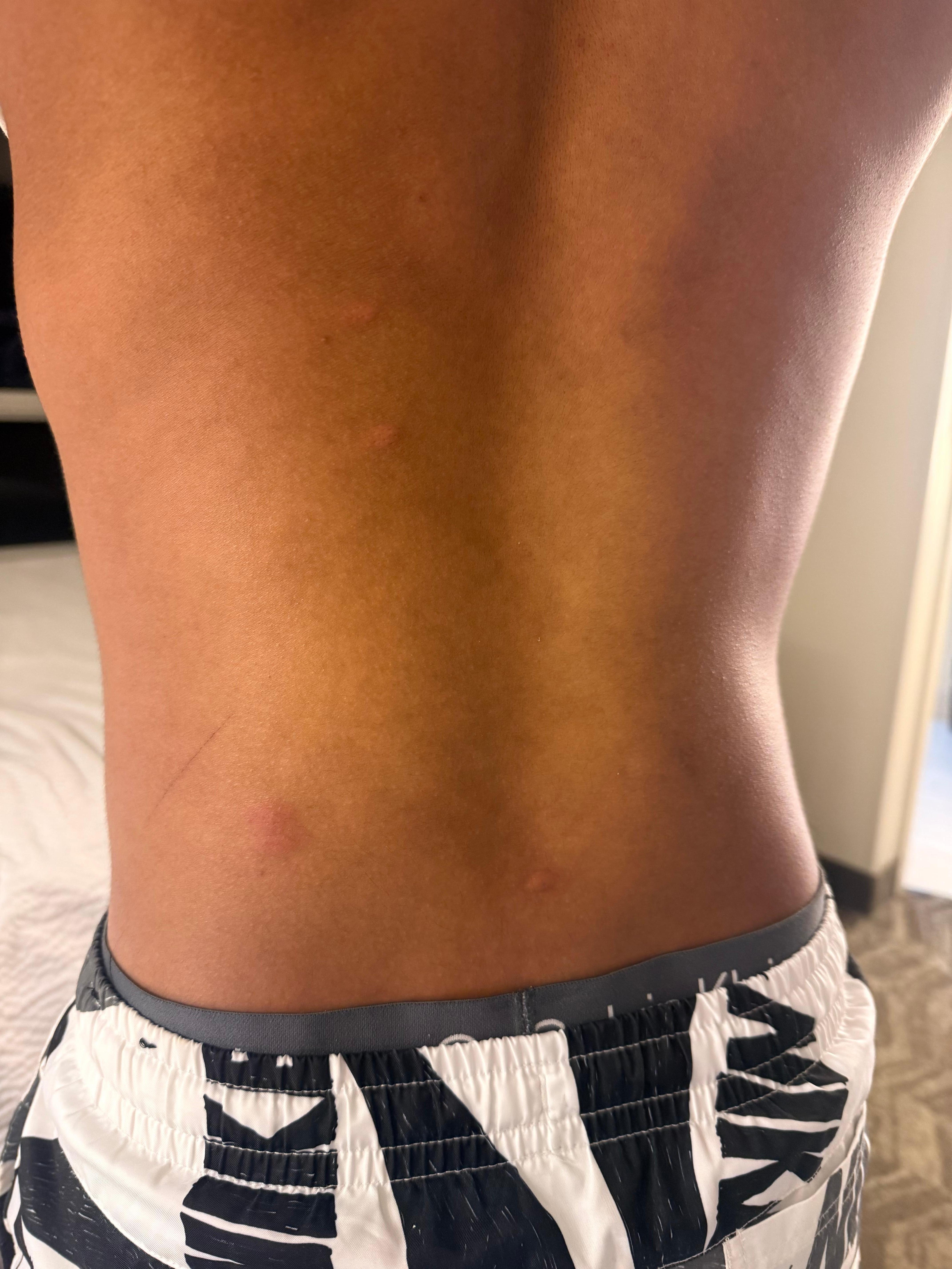 Few Insect bites after sleeping in the bed