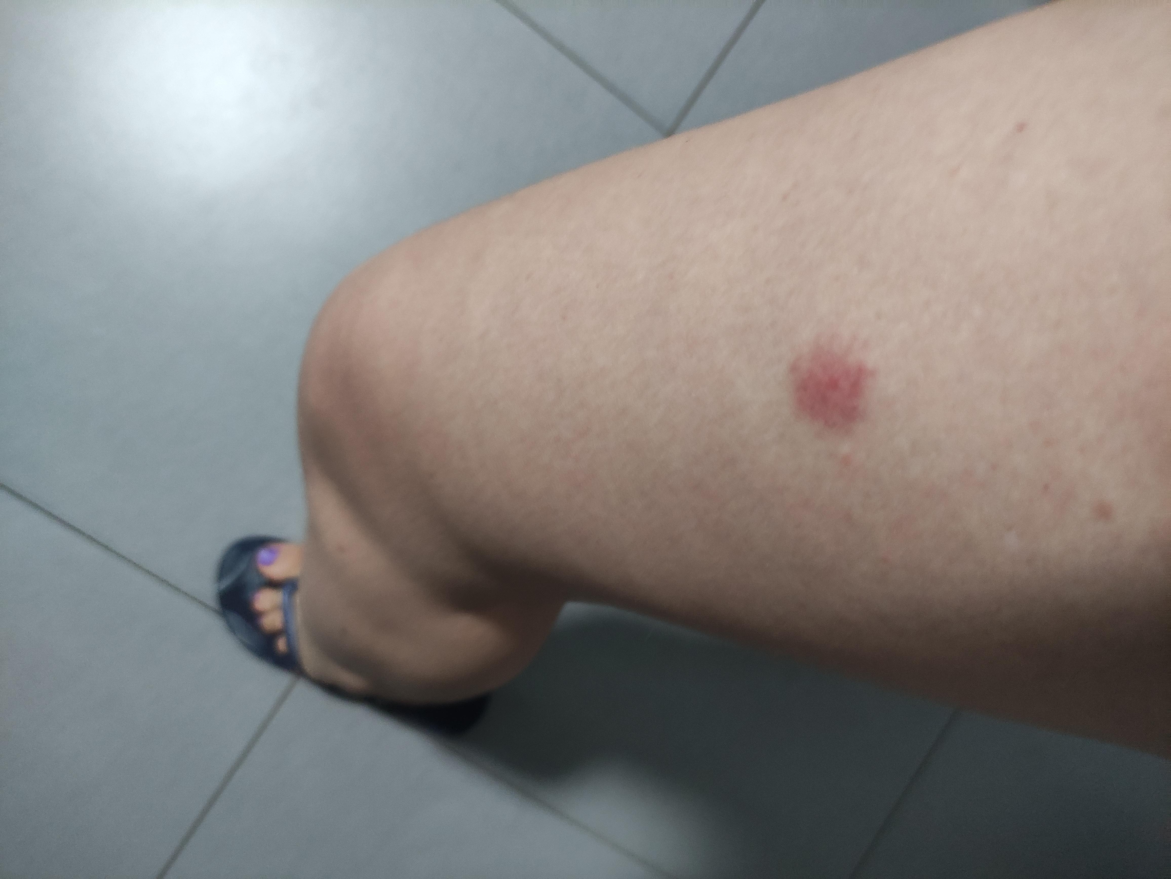 Bed bags bite
