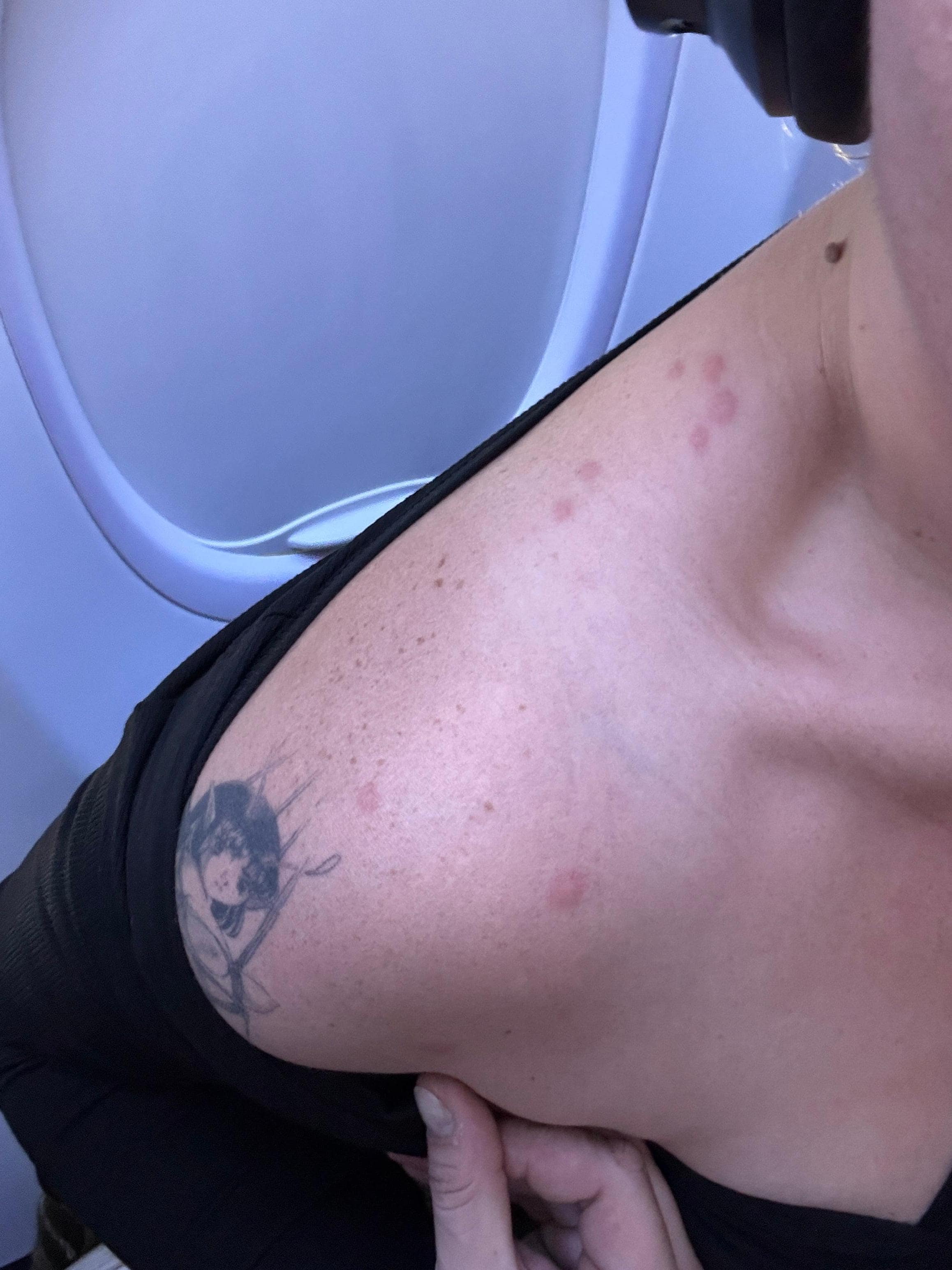 bed bug bites everywhere