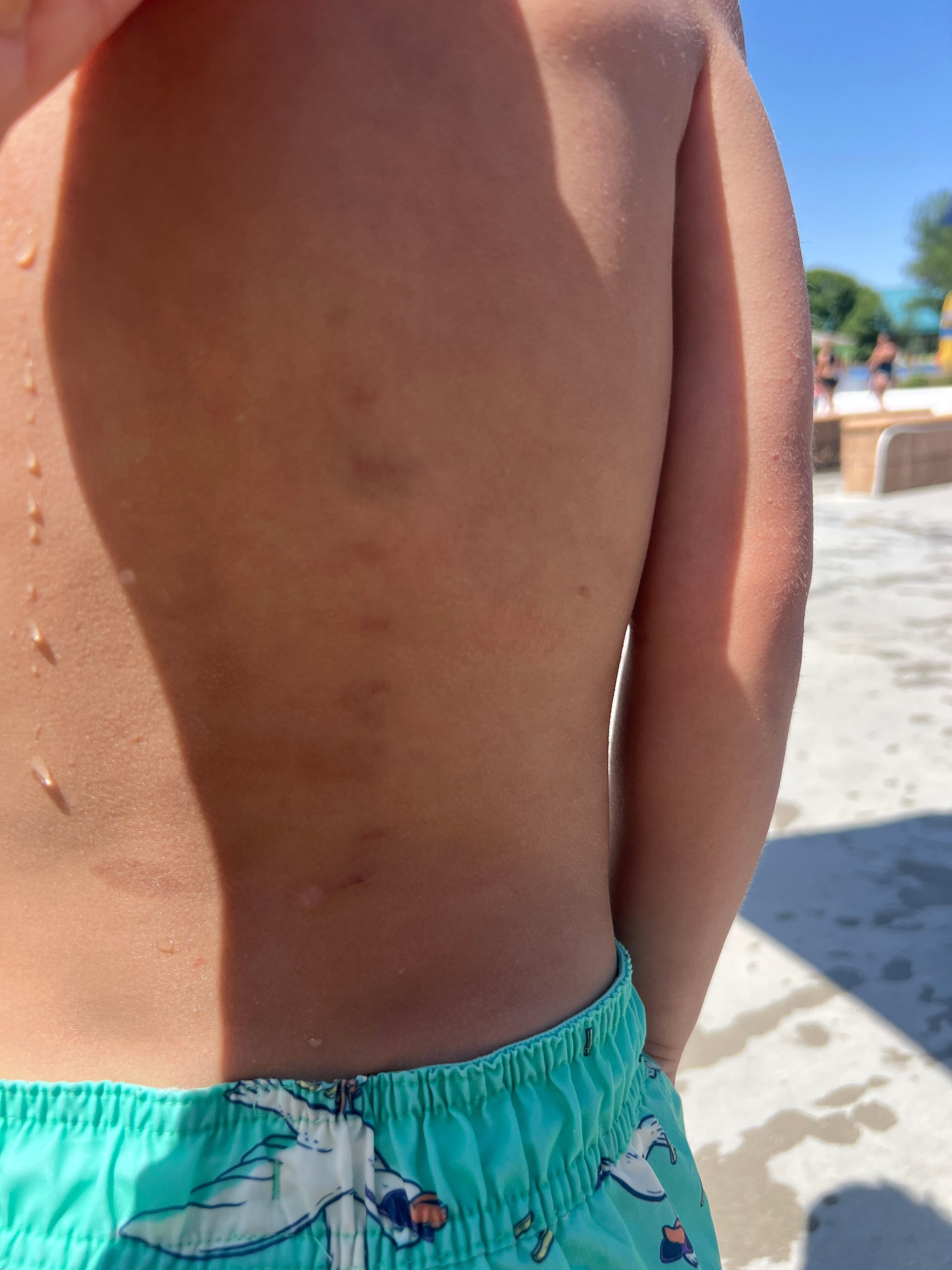 Bruises on my son’s back from slipping at the pool. 
