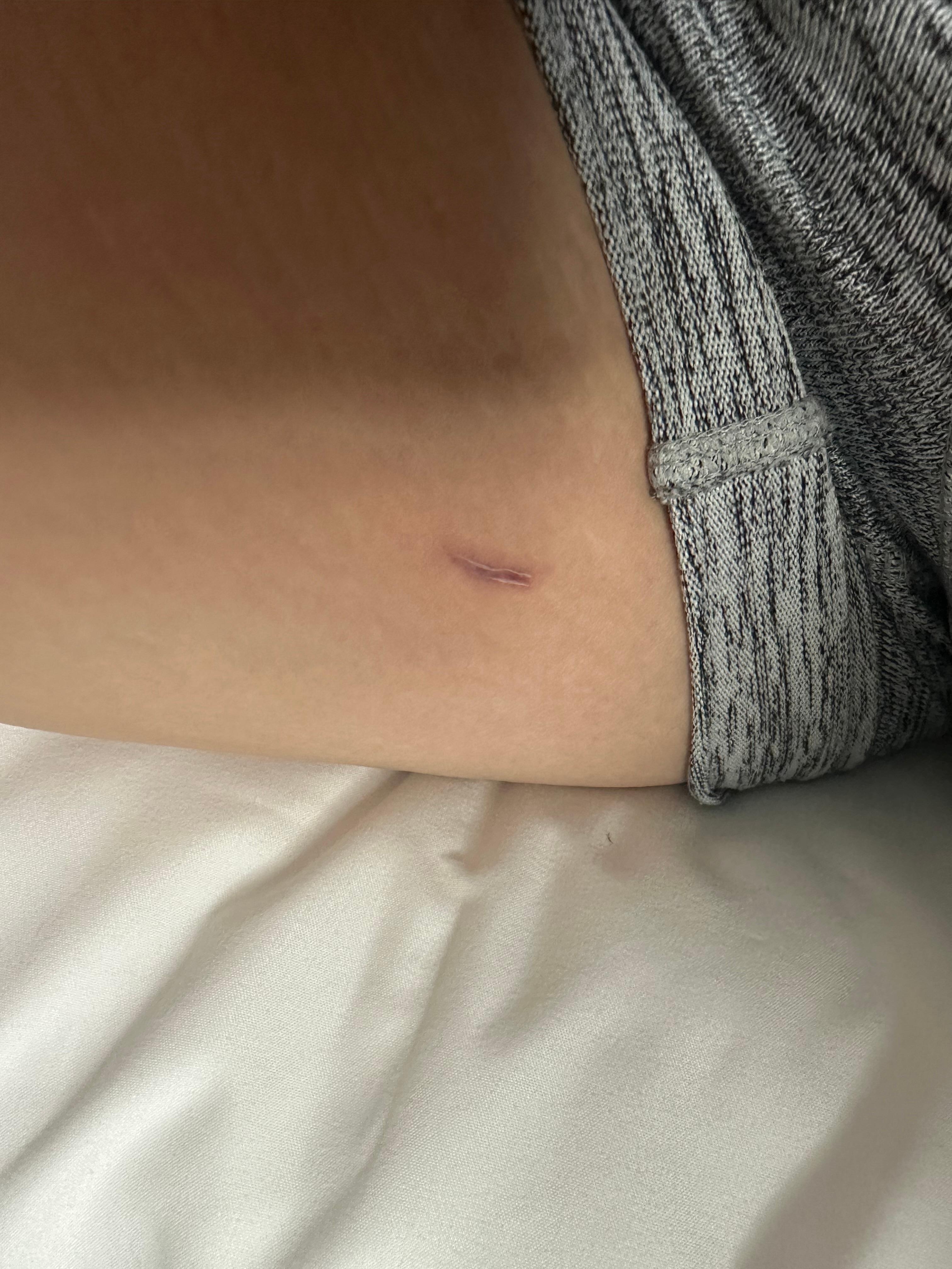 Where the toilet seat bit me because the seat was loose.