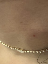 Bed bug bite from the Kompose