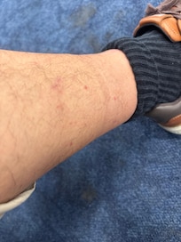 More bites on legs. I actually saw the bugs crawling