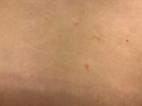 Bed bug bites and reaction
