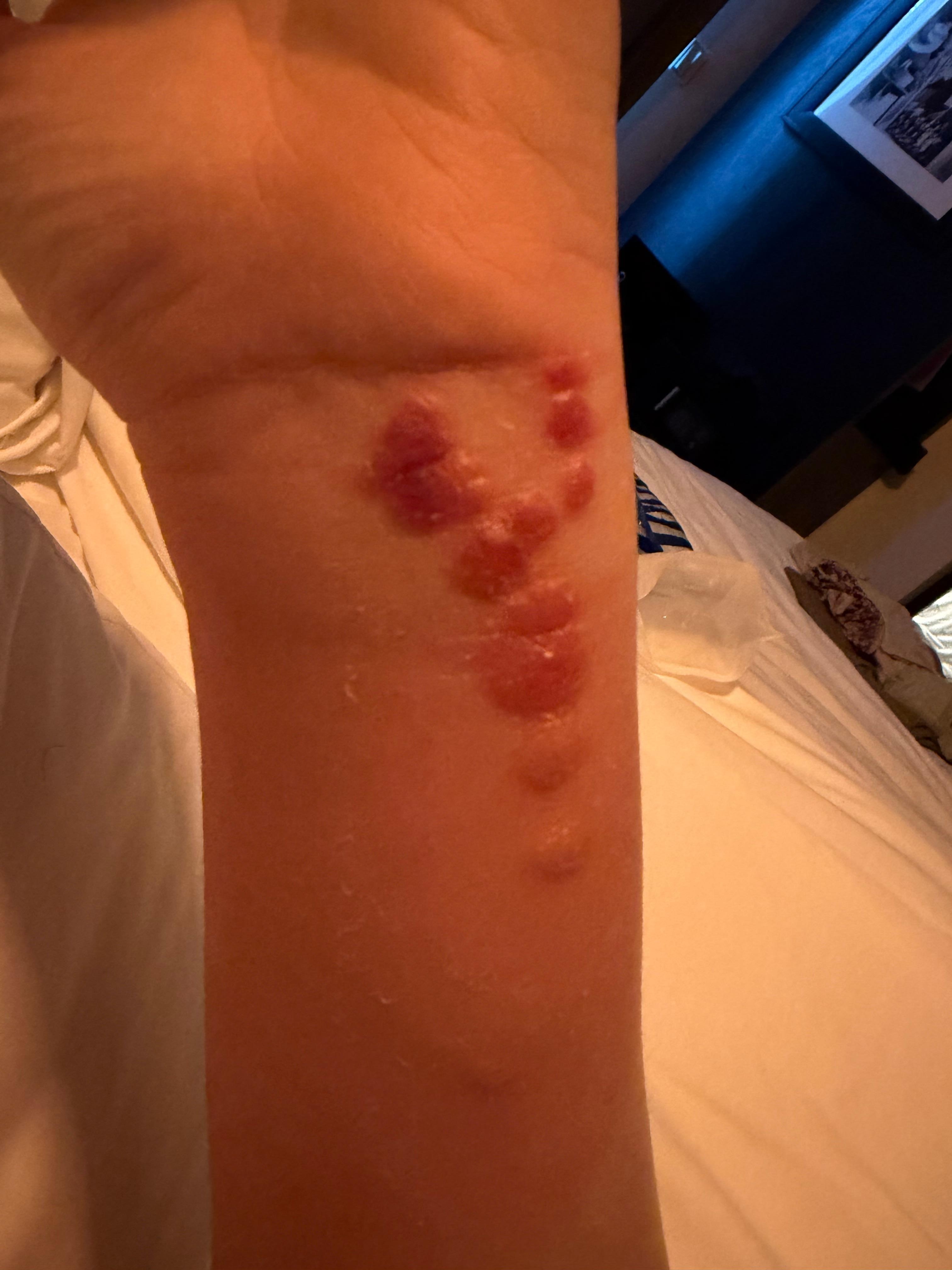 Bed bug bites day 2