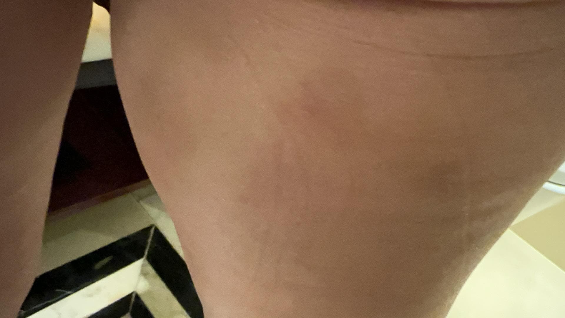 Bed bugs bite marks