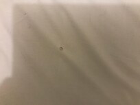 Droit brûlé par cigarette