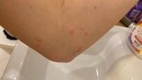 Bites