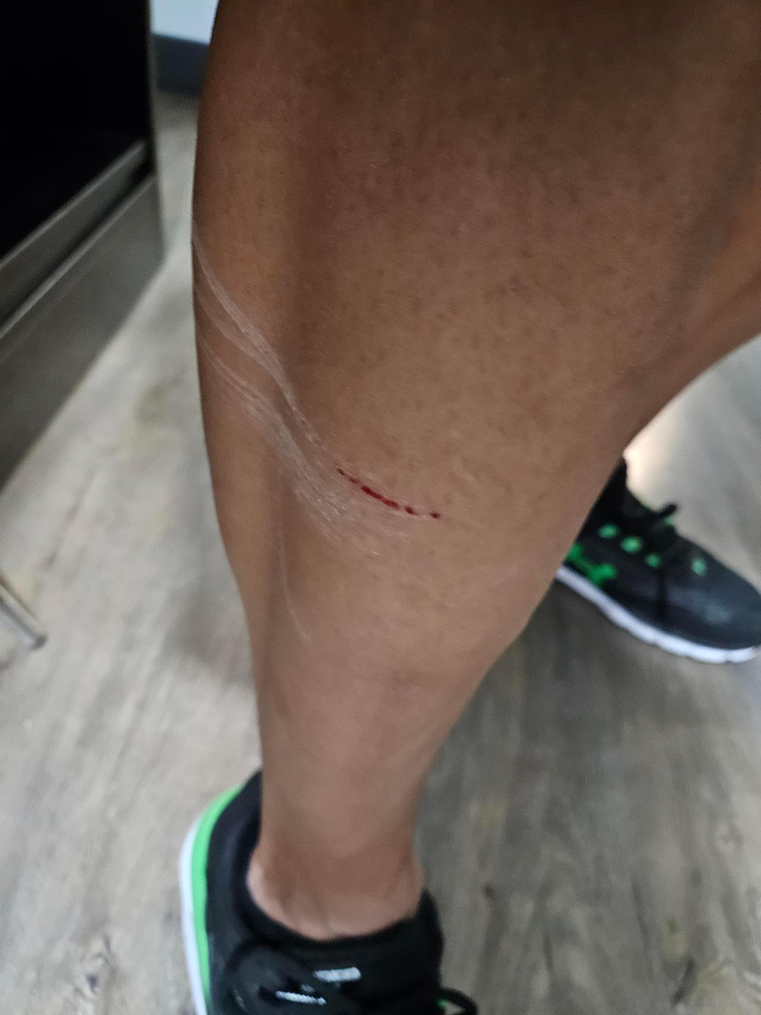 Injury from broken furniture