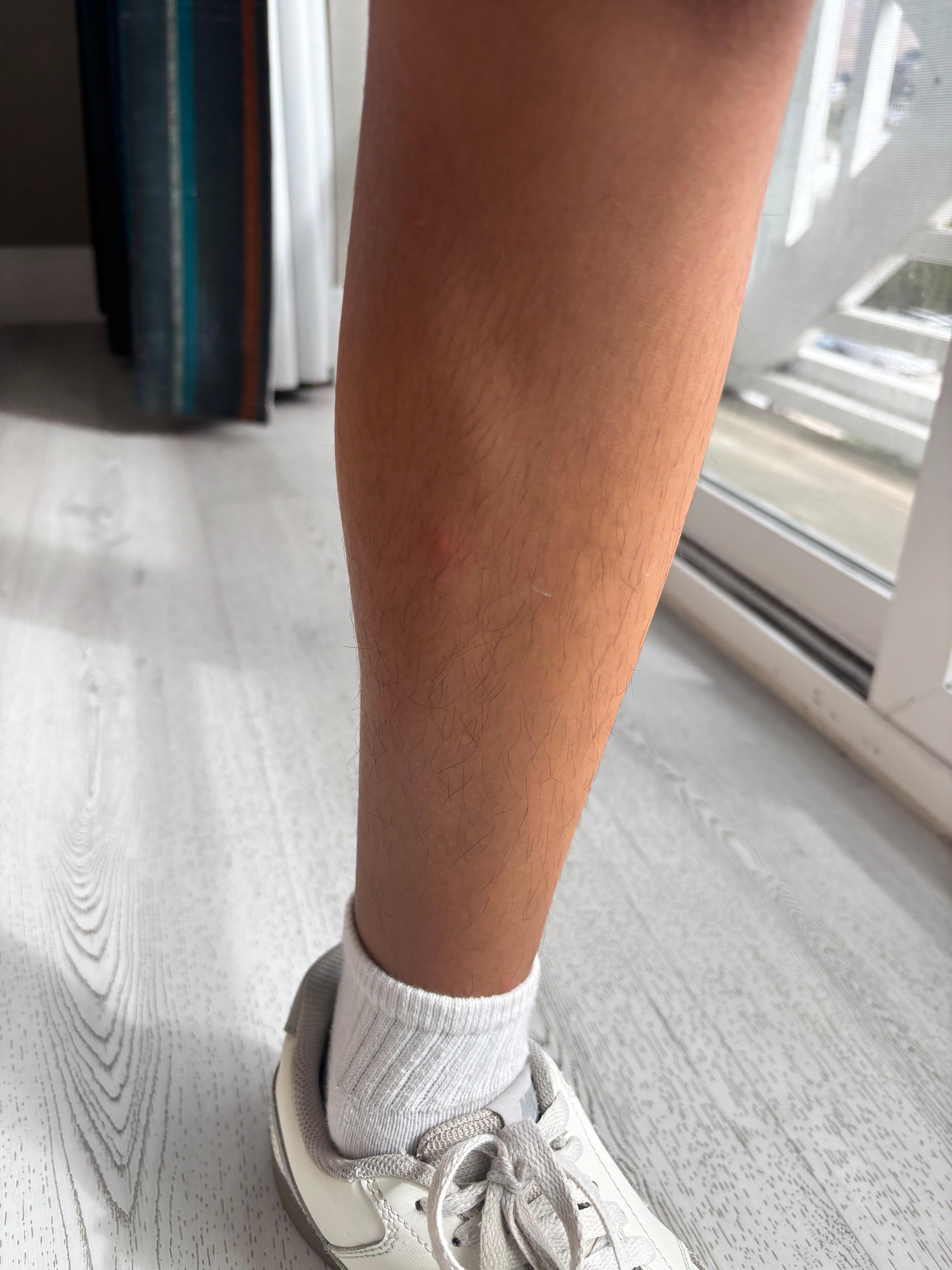 Random bites on his legs after the first night 