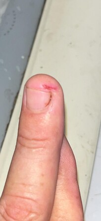 Ya está sanando pero, si van niños si es peligroso