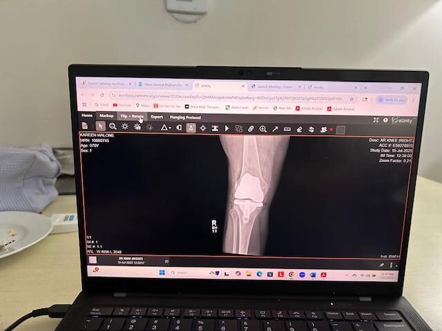 my new knee