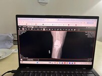 my new knee