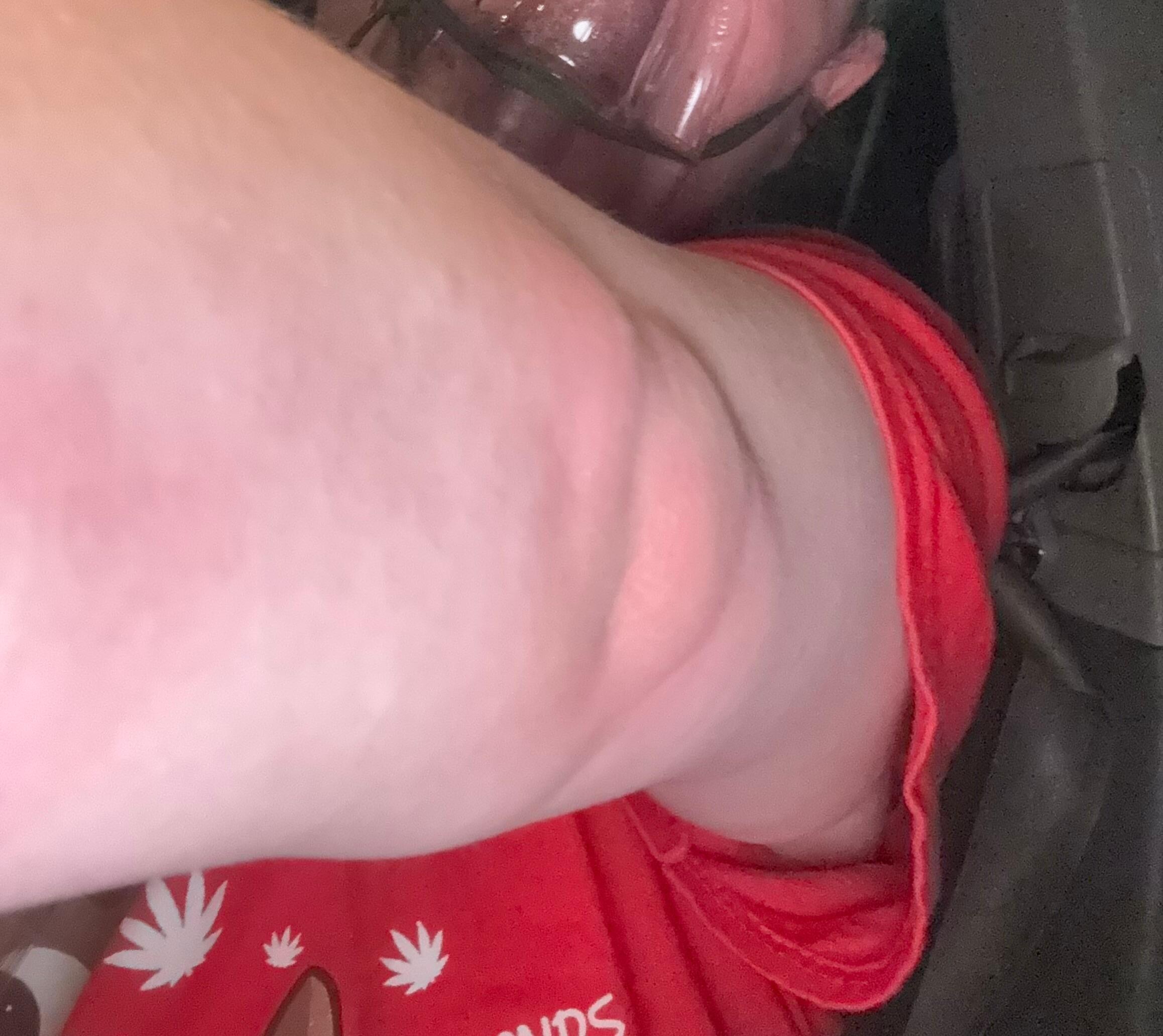 Other arm bites/swelling from bites