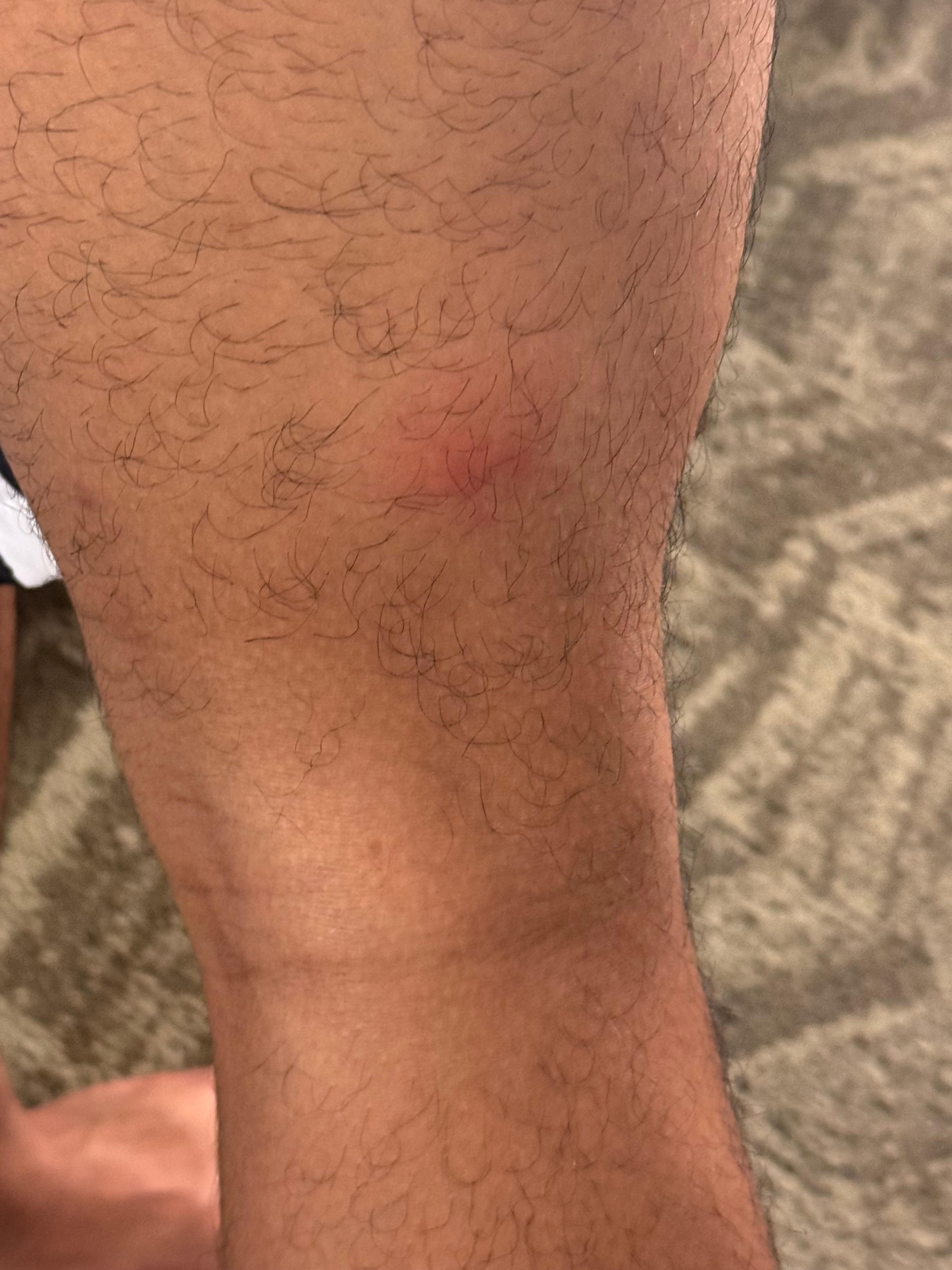 Right legs got 2 insect bites 