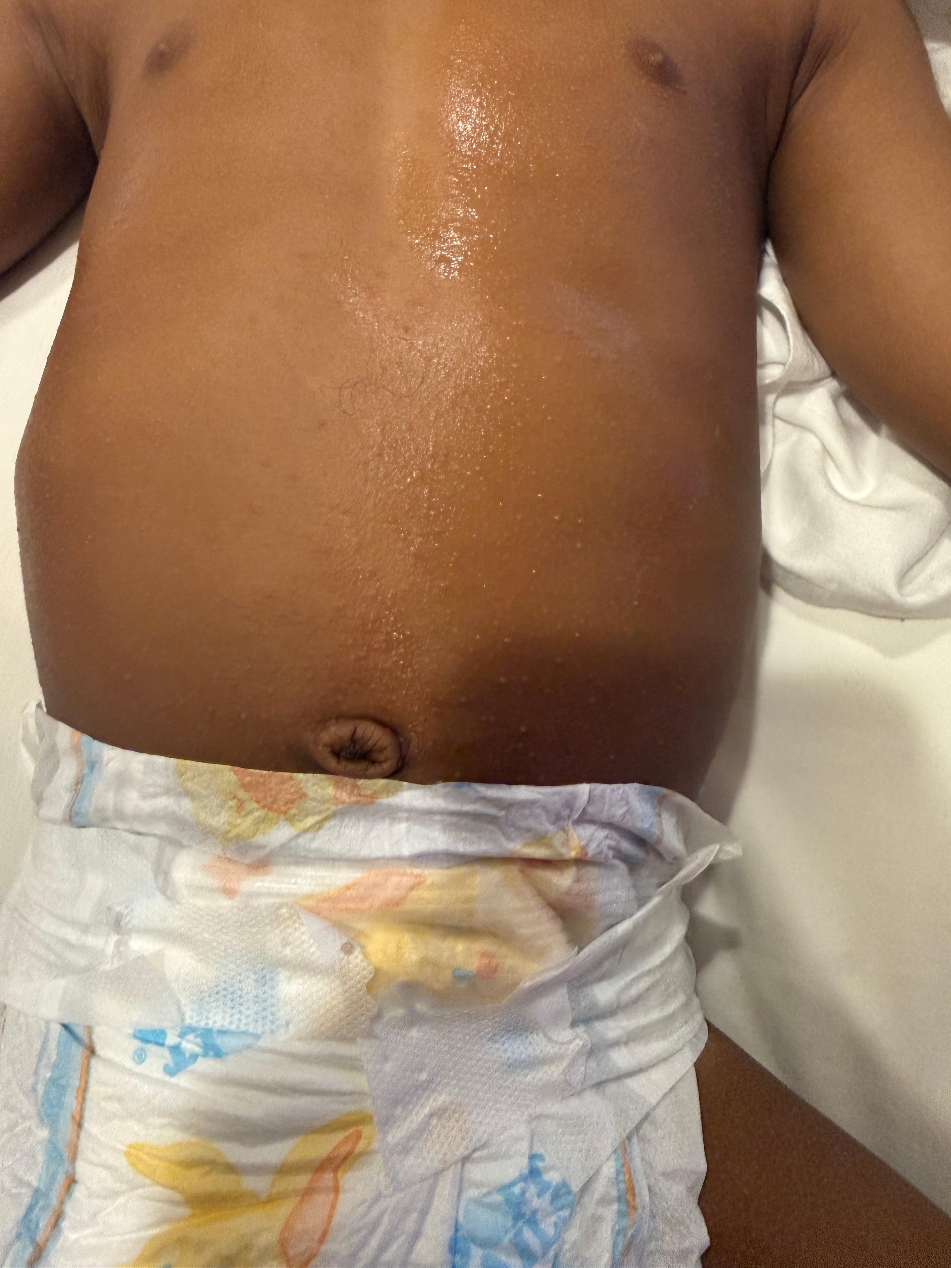 This is a photo of my son’s skin that is completed broken out from the allergens, and dirtyness of the room. 