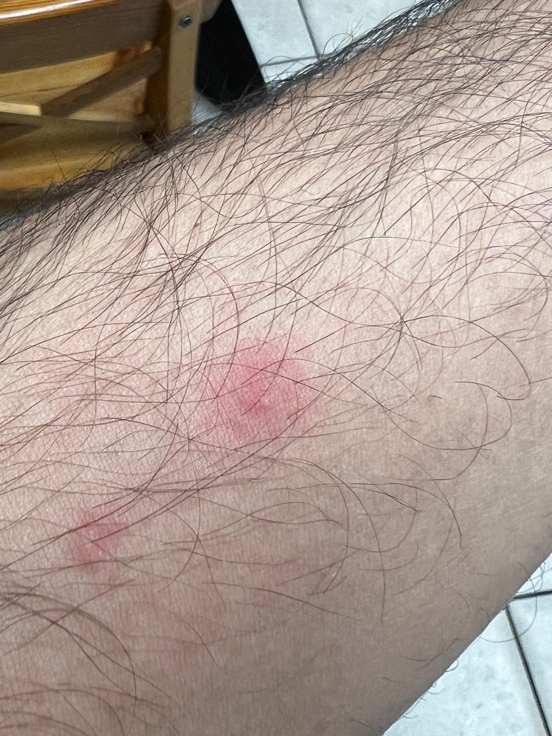 Bug bites after sleeping here!