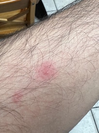 Bug bites after sleeping here!