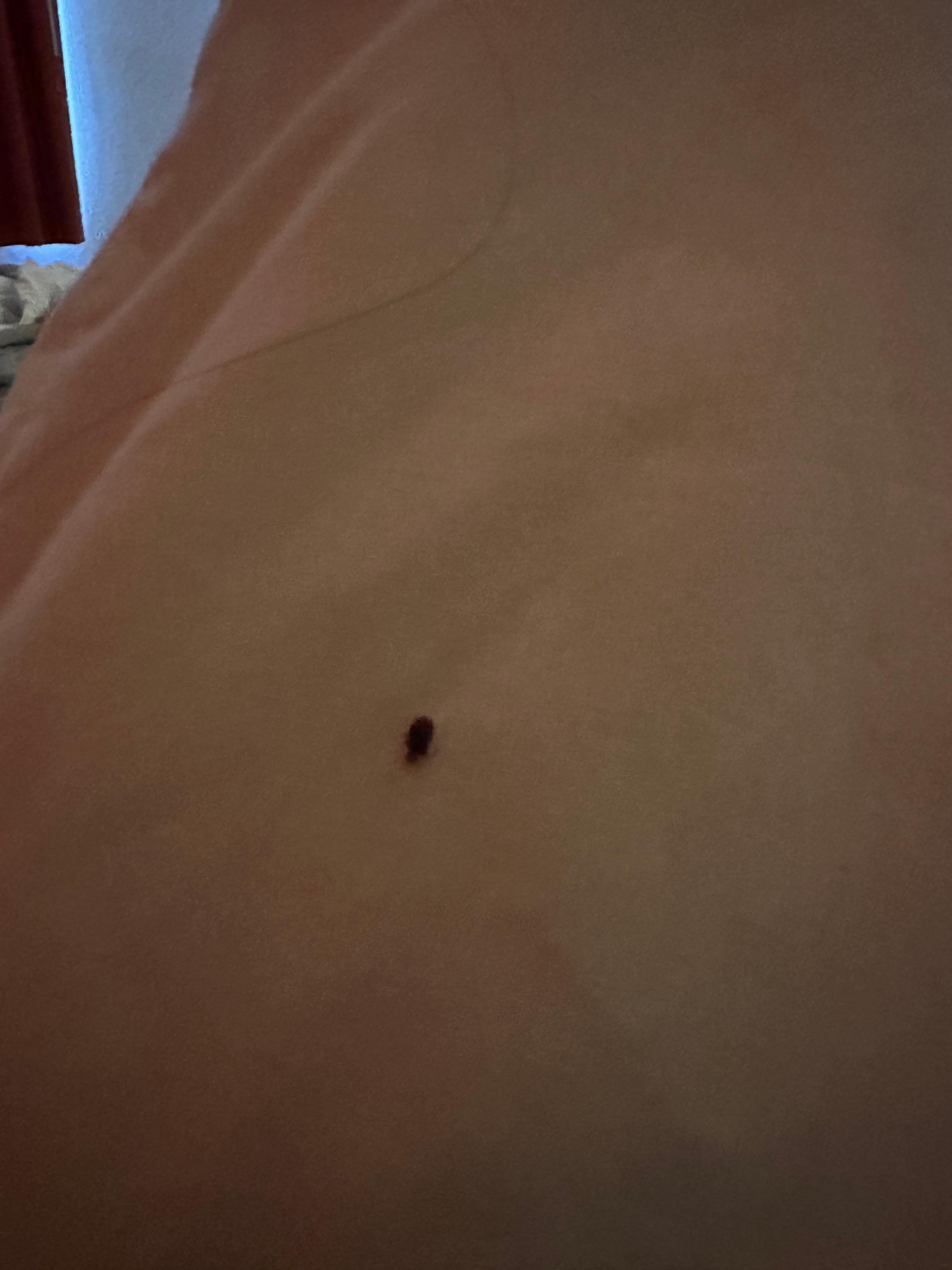 Bed bugs 