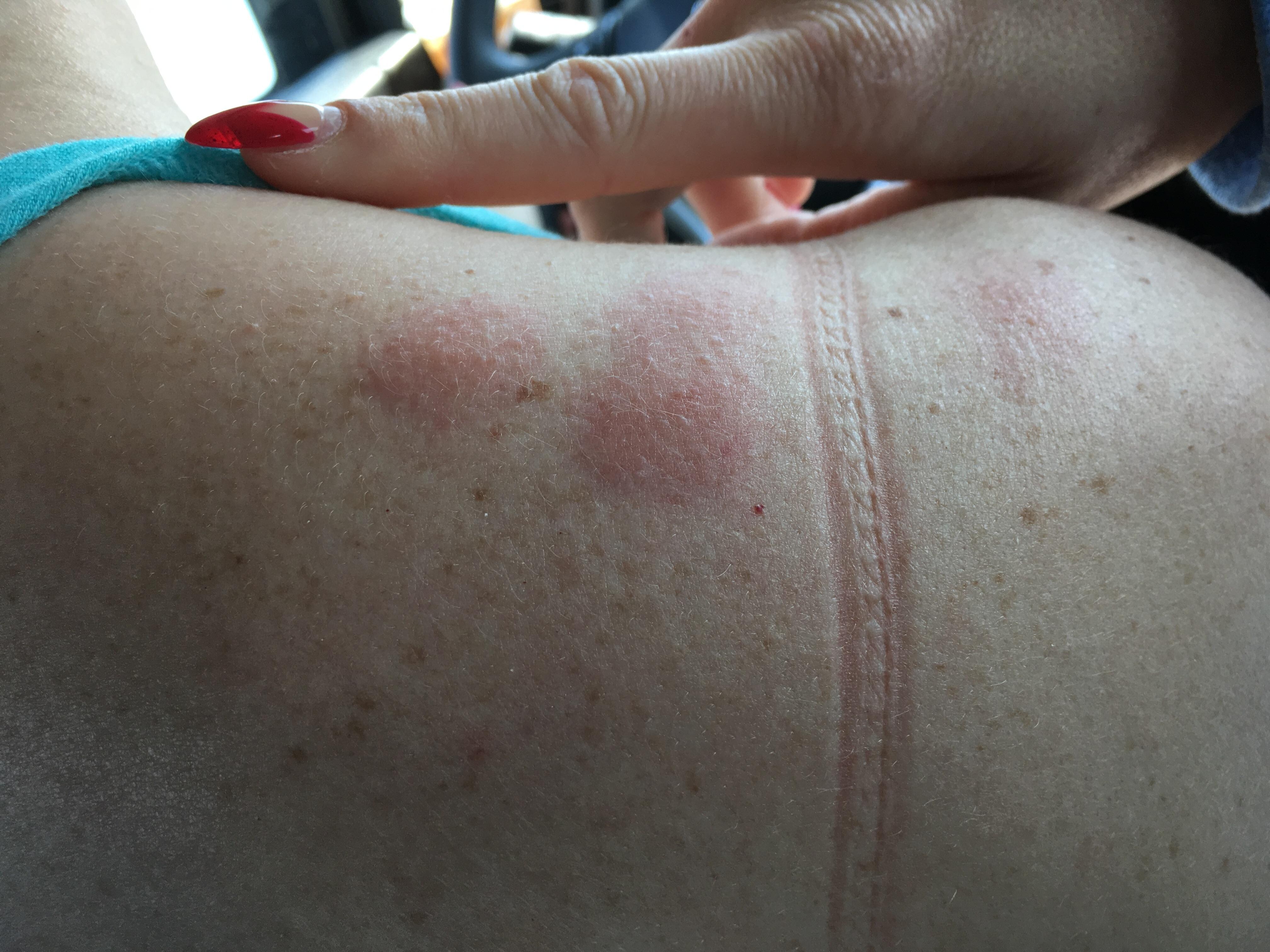 Spider bites!