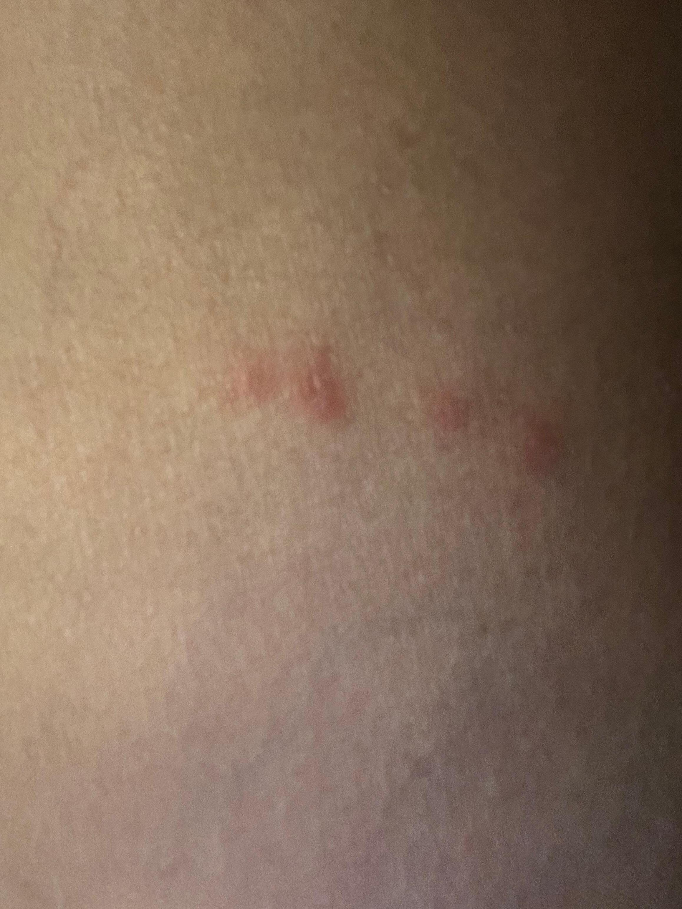 Bed bug bites on my leg 