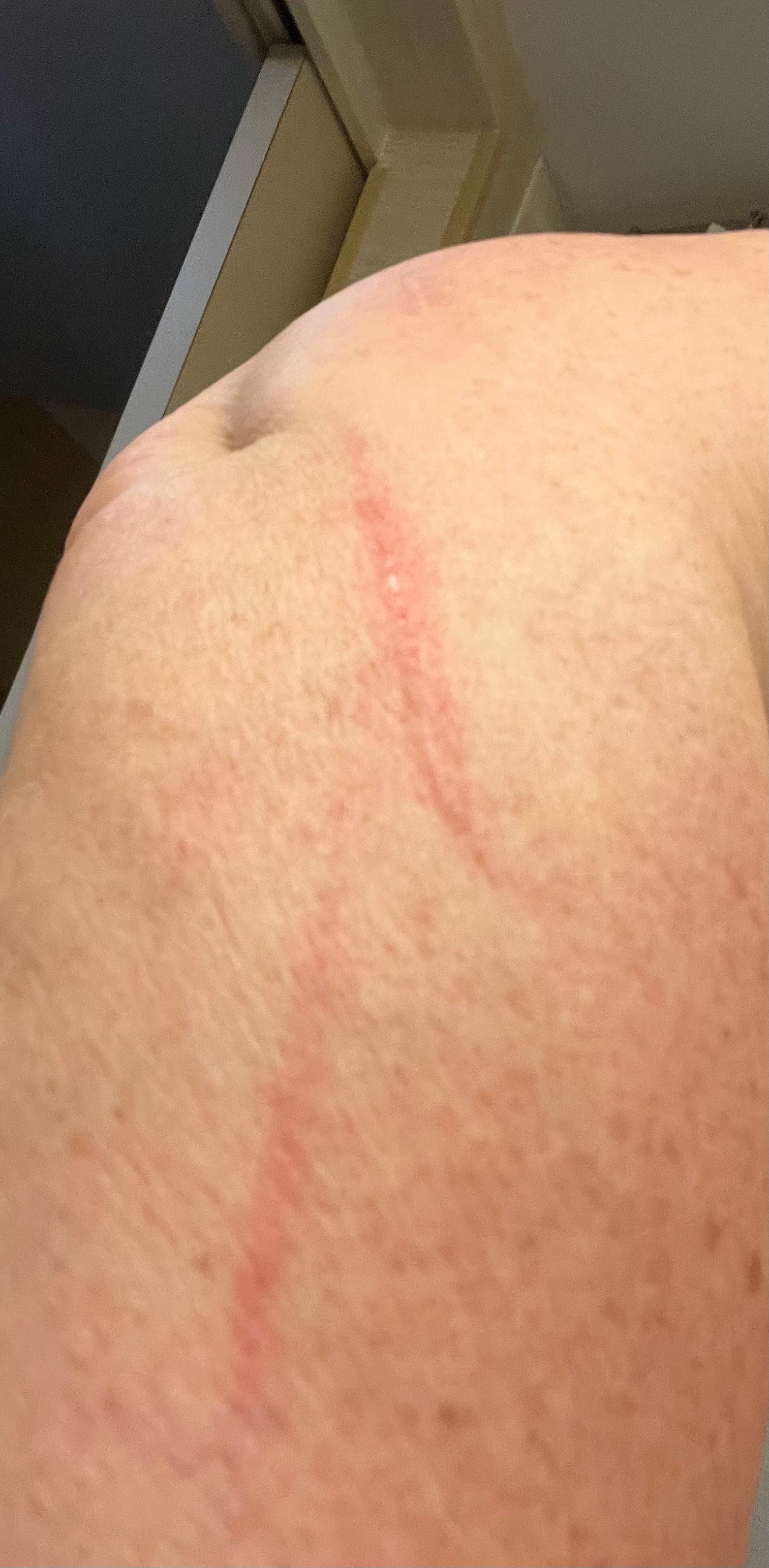 Scrapes on my arm from bumping into the soap dispenser in the shower.