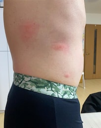 トコジラミに咬まれた、痒い。