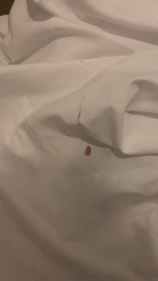 Blood stain on bed sheet 