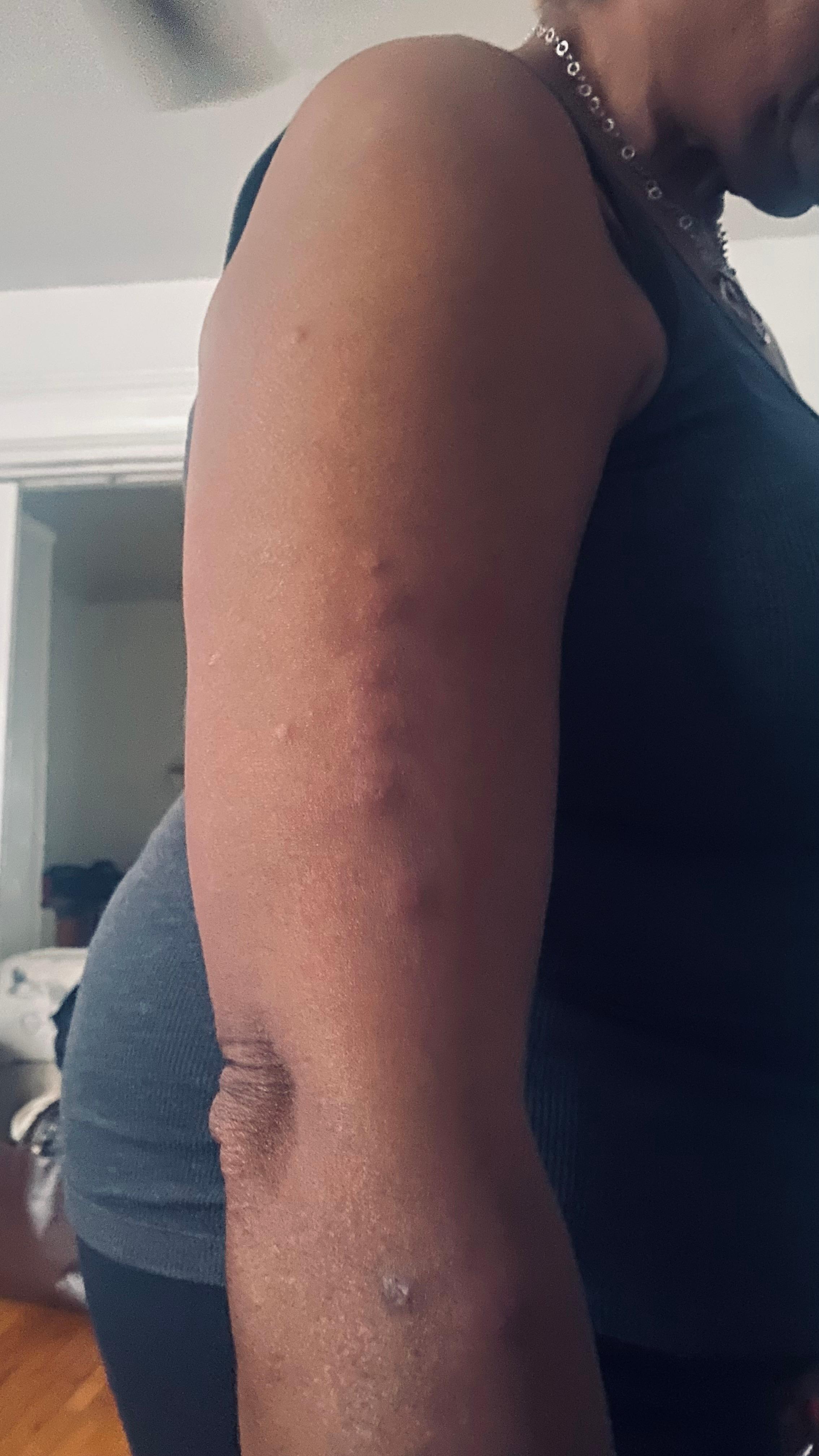 Bedbug bites