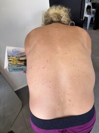 Approximately 50 bed bug bites on my back the next morning.