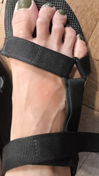 Bites