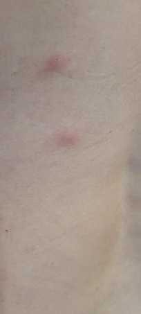 Bites