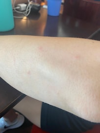 From sleeping. We thought it might be bed bugs but then realized all the mosquitos coming in at night.